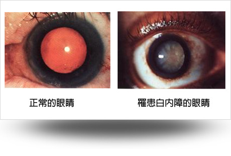 白內障的眼睛與正常眼睛比較